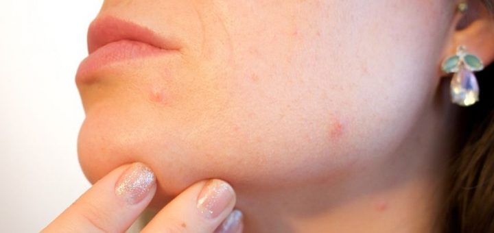 papki, akne